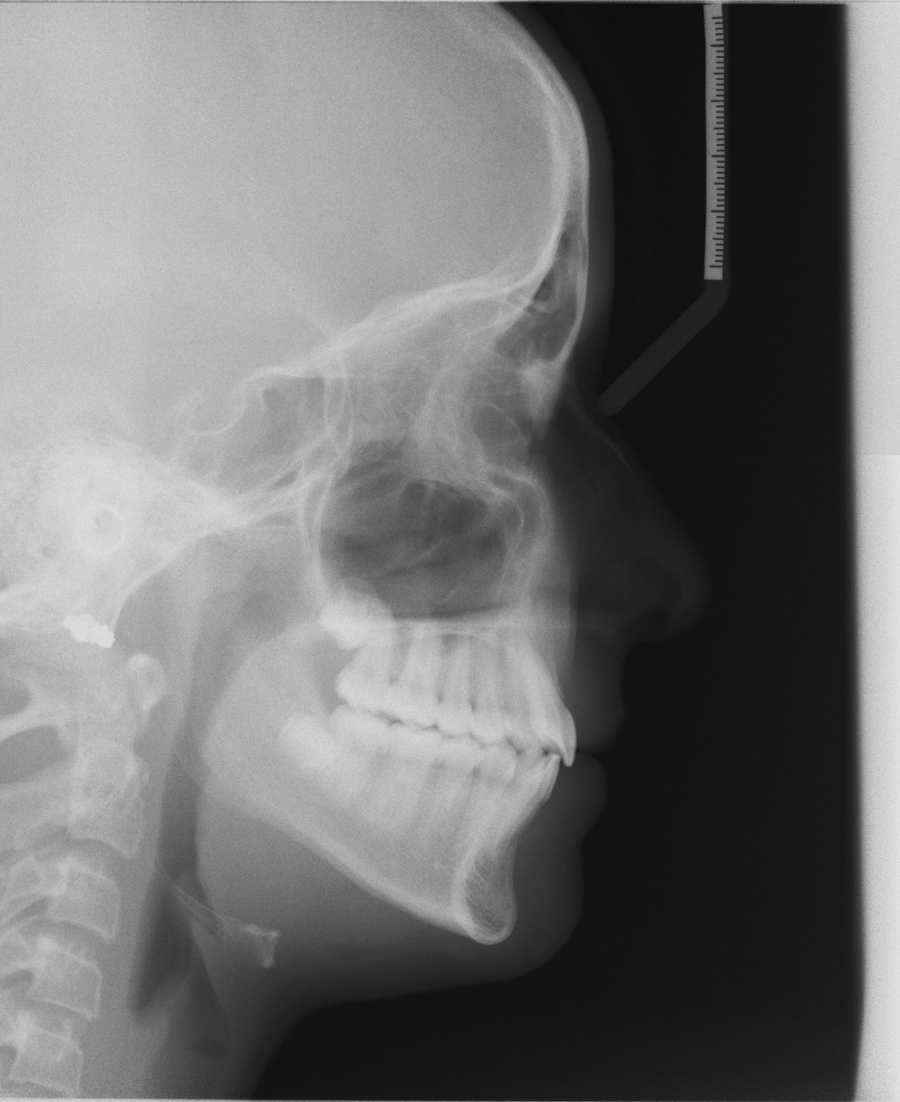 Invisalign for Bite Correction & Alignment Issues