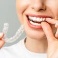 8 Questions to Ask Before Getting Invisalign